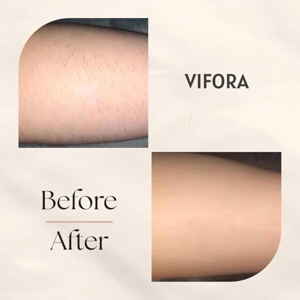 Vifora Ipl Laser Hair Removal Handset - Image 7